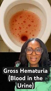 Gross Hematuria- seeing blood in your pee