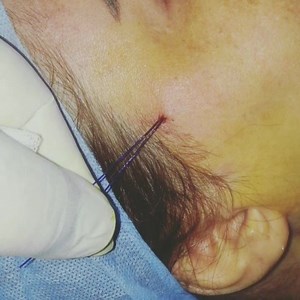 1.6K views · 85 reactions | Prise en charge de 2/3 inférieur du visage par Un Mini lifting là séance c'est très bien déroulé sous anesthésie locale... | Docteur hank médecin esthétique & anti âge | Facebook