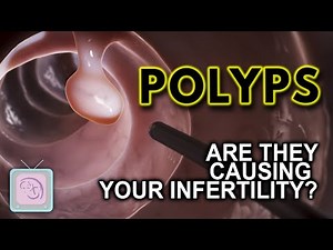Uterine polyps: Removal for infertility?