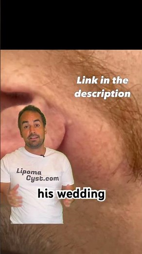 I decided to take on the largest ear cyst iv ever seen. Full video Link in the bio