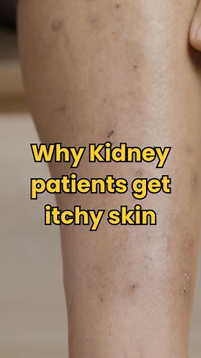 Itchy skin (uremic pruritus) is common in CKD — here’s why 👇 ✔️ Buildup of urea & phosphorus under skin ✔️ Dryness from fluid imbalance ✔️ Nerve irritation from toxins ✅ Relief tips: Moisturize daily. Keep phosphorus under control. Avoid hot showers (they dry skin). Itching = your skin showing what your kidneys can’t filter. 📘 Learn how to ease itching naturally 👉 [Link in BIO] Follow for more. #kidneypatient #kidneydisease #kidneyfailure #kidneydiseaseawareness #usareels | The Kidney Disease