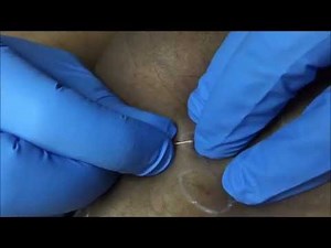 Ingrown Hairs Treatment. Professional Extraction