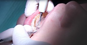 You Will Either Love Or Hate These Viral Teeth Cleaning Videos