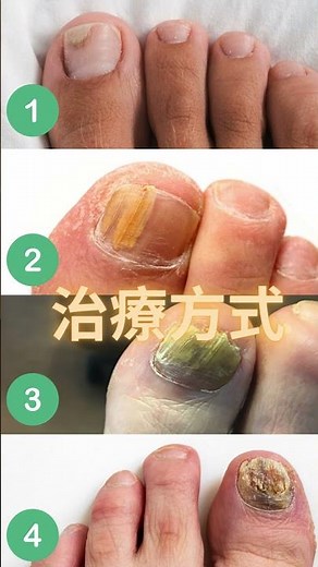 為什麼你灰指甲一直好不了? 全是因爲「這觀念」錯了。#灰指甲 #灰指甲治療 #腳部健康 #健康科普