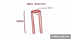 Aortic Dissection - causes, symptoms, diagnosis, treatment, pathology on Make a GIF