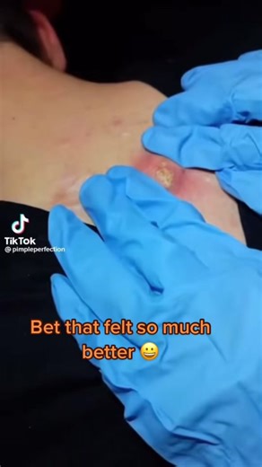 #fyp #reaction #rea #warner #warn #pimplesandblackheads #pimplesandblackheads #dermdoctor #foryou #cystexplosion #cyst #dre #fypシ