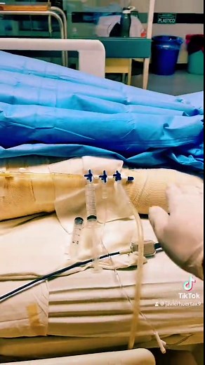 Medición de Presión Intra Abdominal en Enfermería
