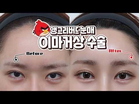 화난 인상, 답답한 눈매... 나에게 딱 맞는 이마거상 수술법은? (전후사진 분석)