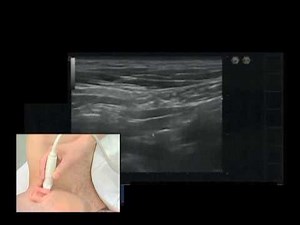 Third Occipital Nerve & Cervical Medial Branch Block