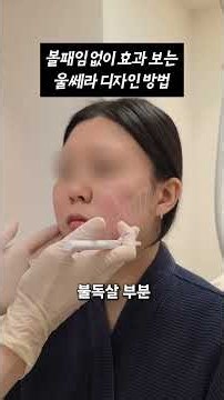 How to Design Ultherapy for Maximum Results Without Hollow Cheeks