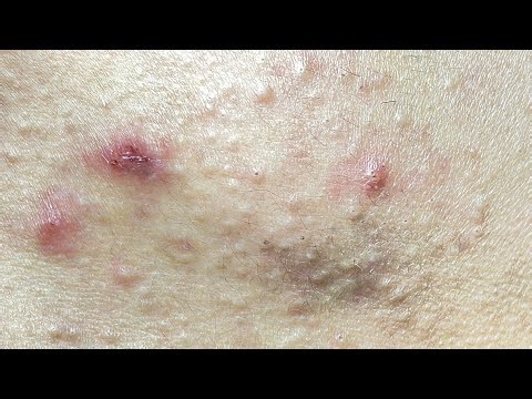 Relaxing Acne Cleansing with LinhMyDang #613