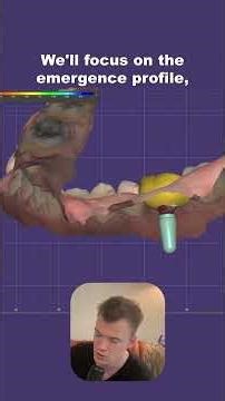 exocad Case Redesign