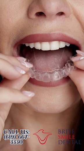 Clear Aligners: Braces Alternatives