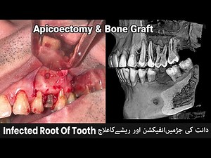 Infected Root Treatment Of Tooth with Apicoectomy Surgery | Live Procedure Video | RCT Infection