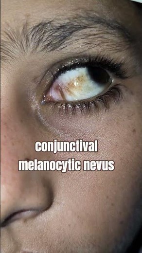 Conjunctival melanocytic nevus — a well-circumscribed, pigmented lesion.