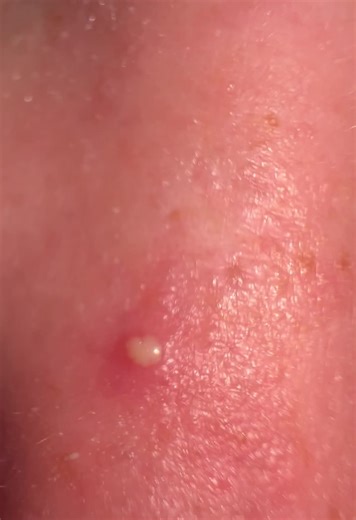 Acne Patch Peels on TikTok