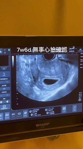 妊娠初期の心拍確認と検診の感動体験
