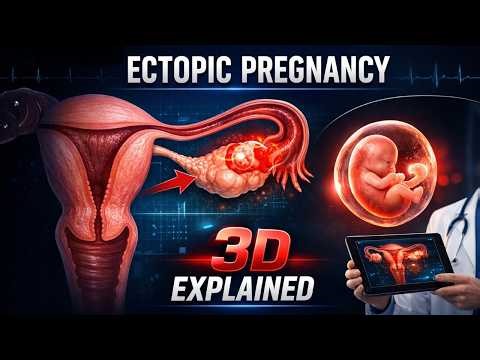 Ectopic Pregnancy Explained in 3D | Medical Animation | Doctors | ERemedium