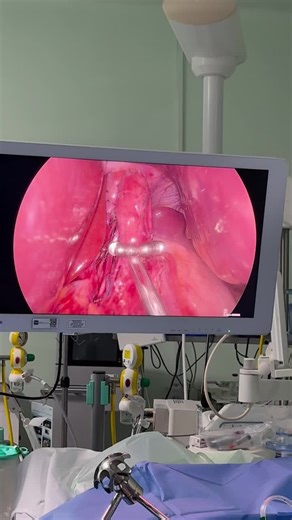 Restoring the natural barrier against reflux — LINX magnetic sphincter augmentation, a minimally invasive solution for chronic GERD. | ahmed Kamal Ahmed