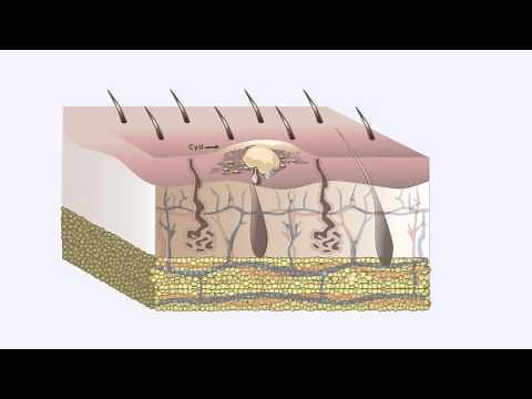 Common Skin Disorders- Cysts
