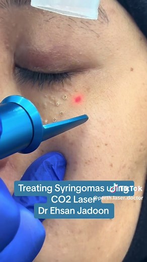 Syringomas are benign eccrine sweat duct tumors, typically found clustered on eyelids, although they may also be found in the armpits, abdomen, chest, neck, scalp, or groin area, including genitals, in a symmetric pattern. They are skin-colored or yellowish firm, rounded bumps, 1–3 mm in diameter, and may be confused with xanthoma, milia, hidrocystoma, trichoepithelioma, and xanthelasma.. They are more common in women and are most commonly found in middle-aged Asian women. While they can present
