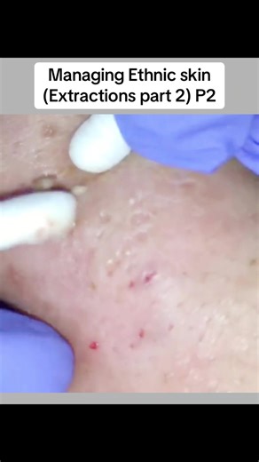 Managing Ethnic Skin: Extractions Techniques Explained