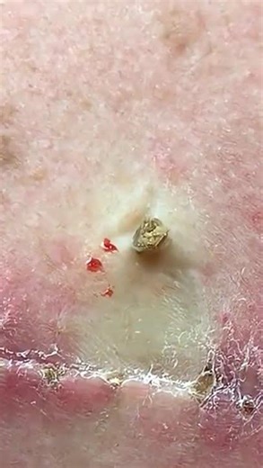 Quick Back Blackheads