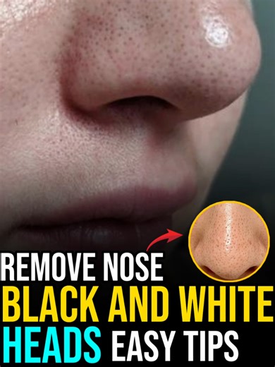 Effective Blackhead Removal Techniques at Home