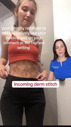 Understanding Erythema Ab Igne and Heating Pad Risks
