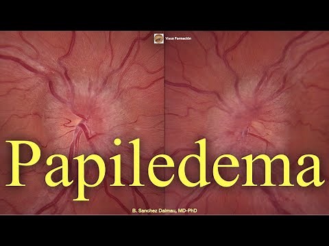 Papilledema. Neurophthalmology.