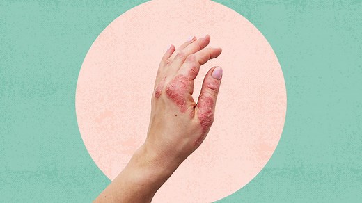 Psoriasis on the Hands and Feet: Types, Symptoms, and Treatments