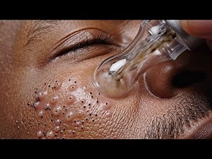 Blackhead Removal: Before & After Transformation (Real Skin)