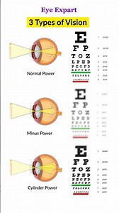 3 Types of Eye Vision 👀#eyevision #eyeexamination #eyes #eyecare #eyetest #optometrist #education