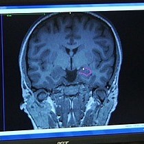 A Comprehensive Protocol for Manual Segmentation of the Medial Temporal Lobe Structures