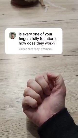 A woman has six fully functional fingers on one hand, enhancing dexterity and precision known as functional polydactyly.