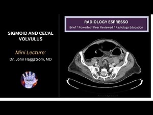 SIGMOID AND CECAL VOLVULUS: Mini Lecture, Dr. John Haggstrom, MD