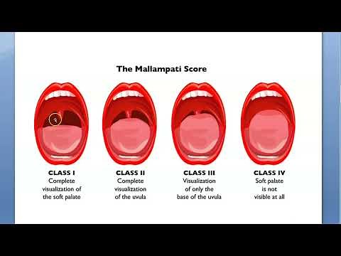 Anesthesia Mallampati score grading MP Airway Evaluation Open mouth Large tongue Intubation PAC