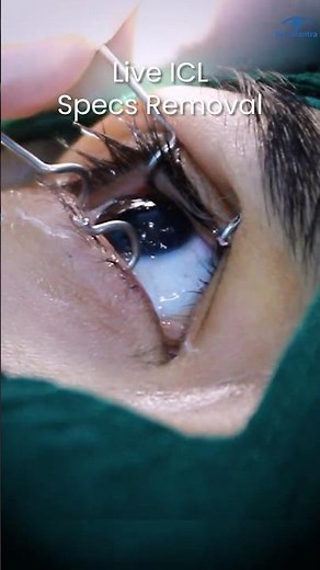LIVE: ICL Surgery For High Power Glasses Removal | Full Procedure Explained