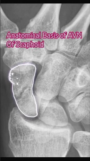 “Scaphoid AVN Explained in 60 Seconds!” #anatomyshorts #anatomy #scaphoid