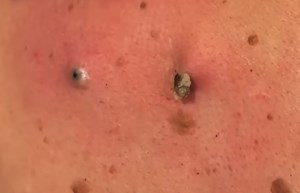 Dilated Pores of Winer Extracted