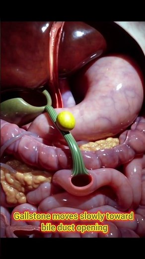Bile Duct Blocked? See How a Tiny Stone Stops Bile Flow