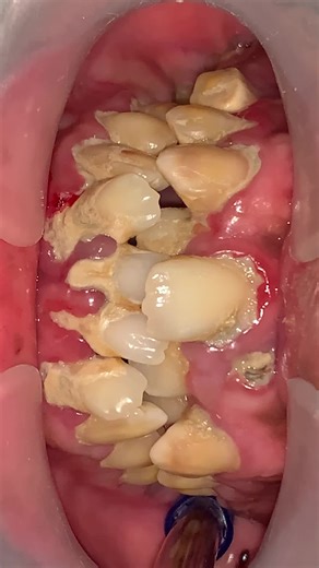 Dental Scaling: Understanding the Process - Part 2