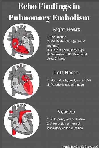 Echo in Pulmonary Embolism...the clot thickens