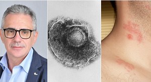 Fuoco di Sant'Antonio, aumentano i casi. Pregliasco: «Attenzione agli occhi». Sintomi, cause, cure e come avviene il contagio