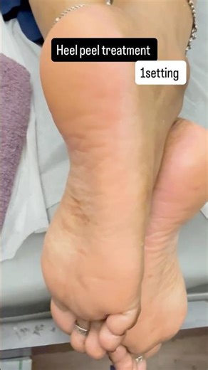 Heel peel treatment for crack heel