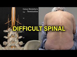 Navigating the Difficult Spinal Anesthesia [Complete 2026 Version]