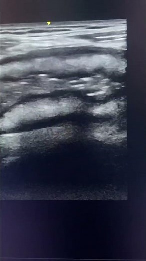 Ulcerative colitis ultrasound #ultrasonography #ultrasoundmadeeasy
