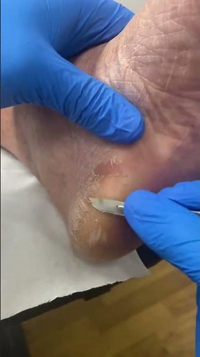 Dive into foot health with our Aussie Podiatrist's Thick Heel Callus removal!