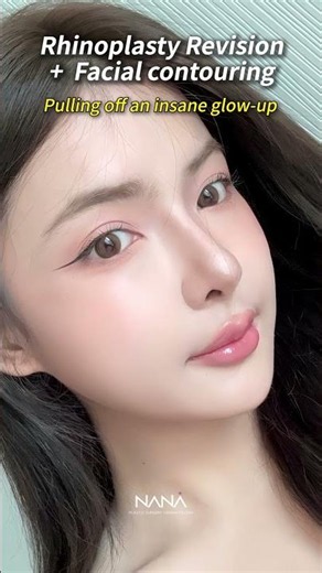 Pulling up an insane glow-up #koreaplasticsurgery