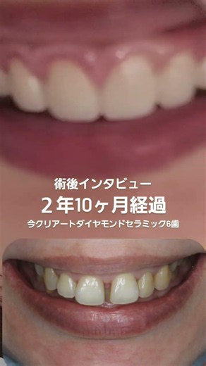 術後インタビュー。２年10ヶ月経過です。愛知県からのモニター様。6歯今クリアートダイヤモンドセラミック